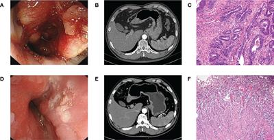 Safety and efficacy of tislelizumab plus chemotherapy versus chemotherapy alone as neoadjuvant treatment for patients with locally advanced gastric cancer: real-world experience with a consecutive patient cohort